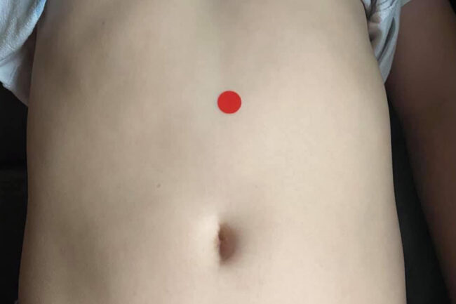 kg12 Akupressurpunkt Kg12