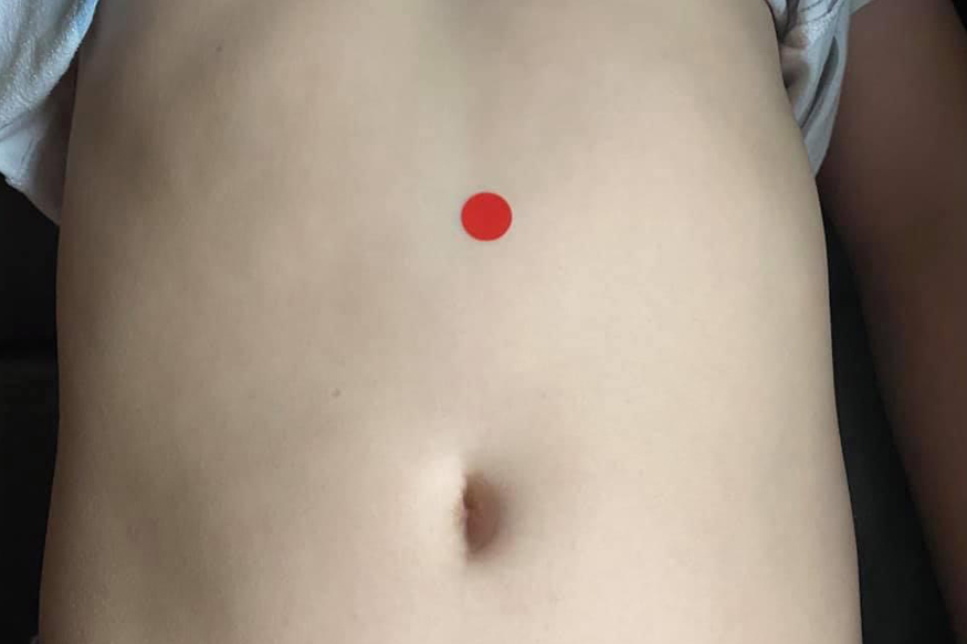 kg12 Akupressurpunkt Kg12