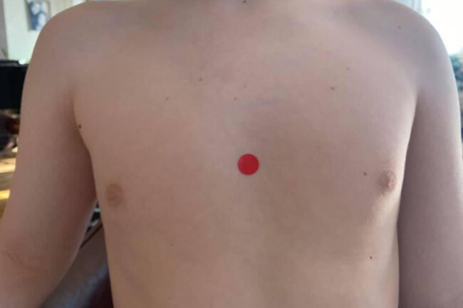 kg17 Akupressurpunkt Kg17