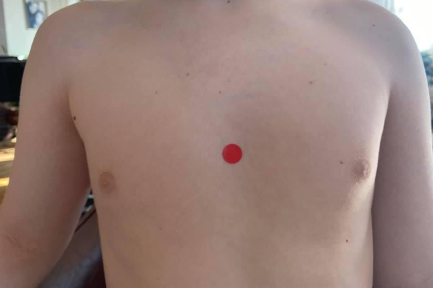 kg17 Akupressurpunkt Kg17