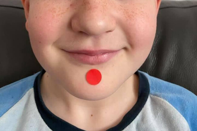 kg24 Akupressurpunkt Kg24