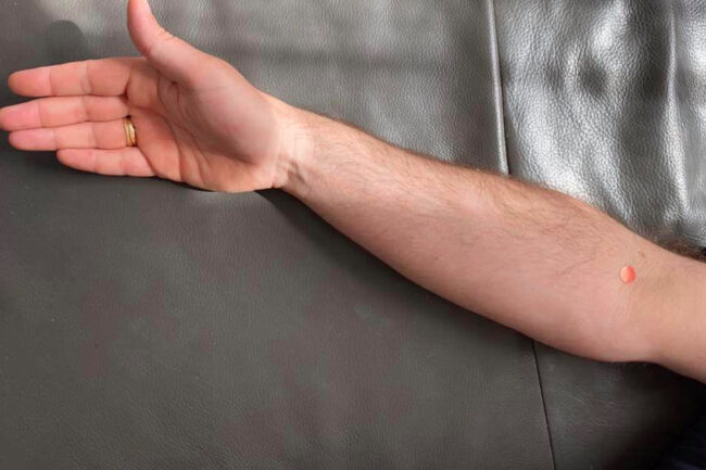 lu5 Akupressurpunkt Lu5