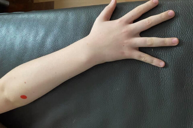 np67 Akupressurpunkt Np67